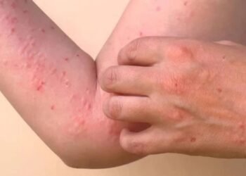 Hello Telugu - Chikungunya Effective Symptoms