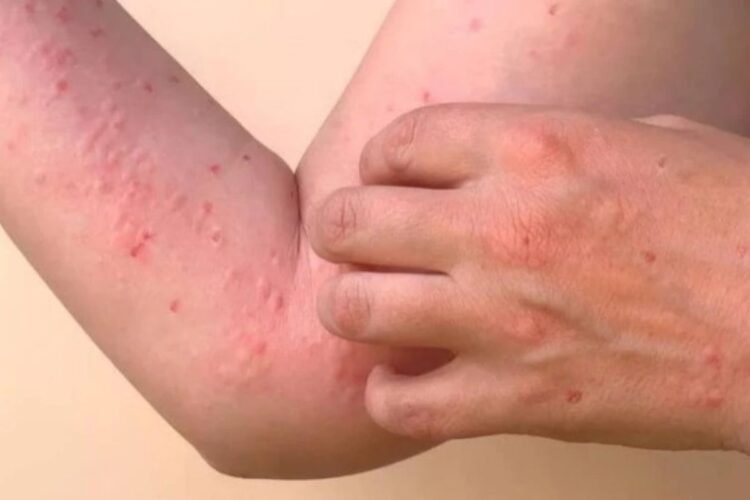 Hello Telugu - Chikungunya Effective Symptoms