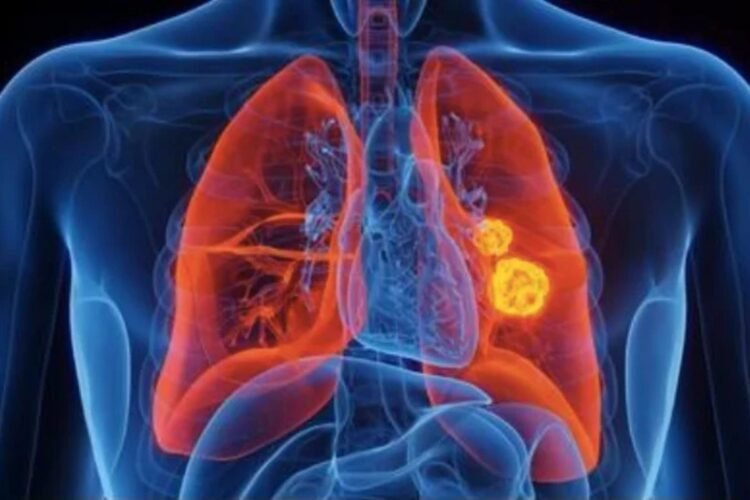Hello Telugu - Rising Lung Cancer Sensational